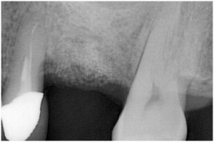 篠崎６ GBR　GBR後約1年・拡大写真